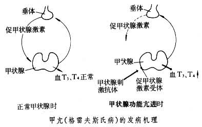 简称甲亢