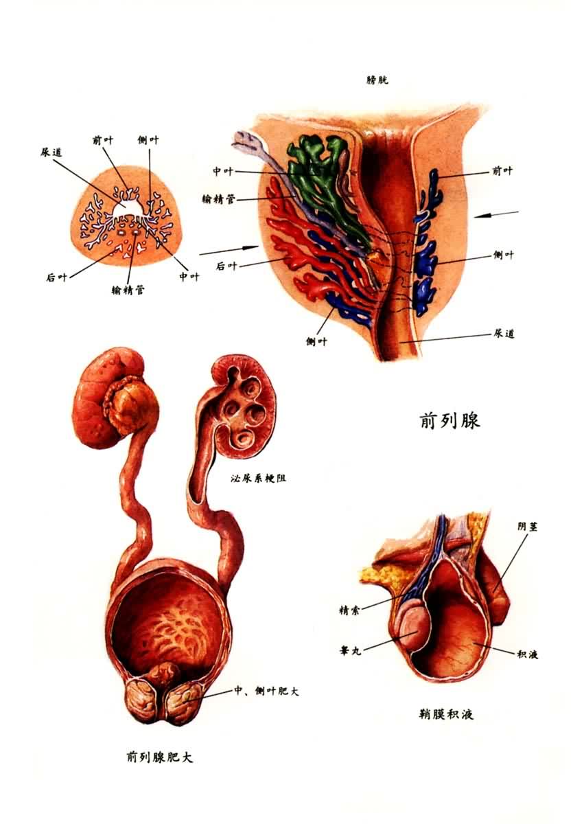 概述 鞘膜原是腹膜的一部分,在胎儿睾丸下降时成为腹膜鞘突,以后随