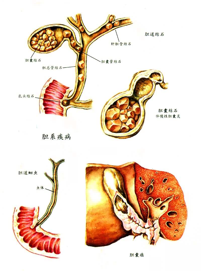 肝内外输送胆汁通道的疾病;肝外胆道系统包括储存胆汁的胆囊