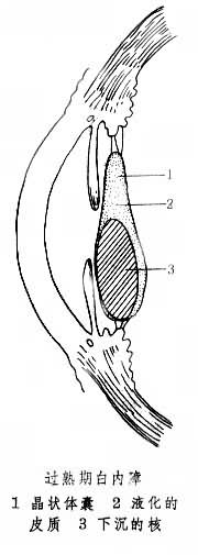 白內(nèi)障