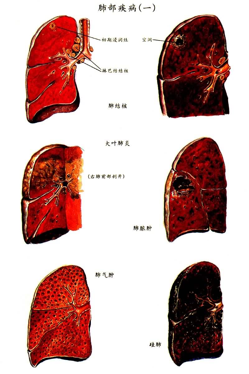 肺部疾病