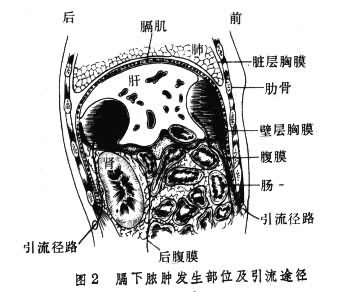 腹腔脓肿