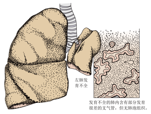 肺發(fā)育不全