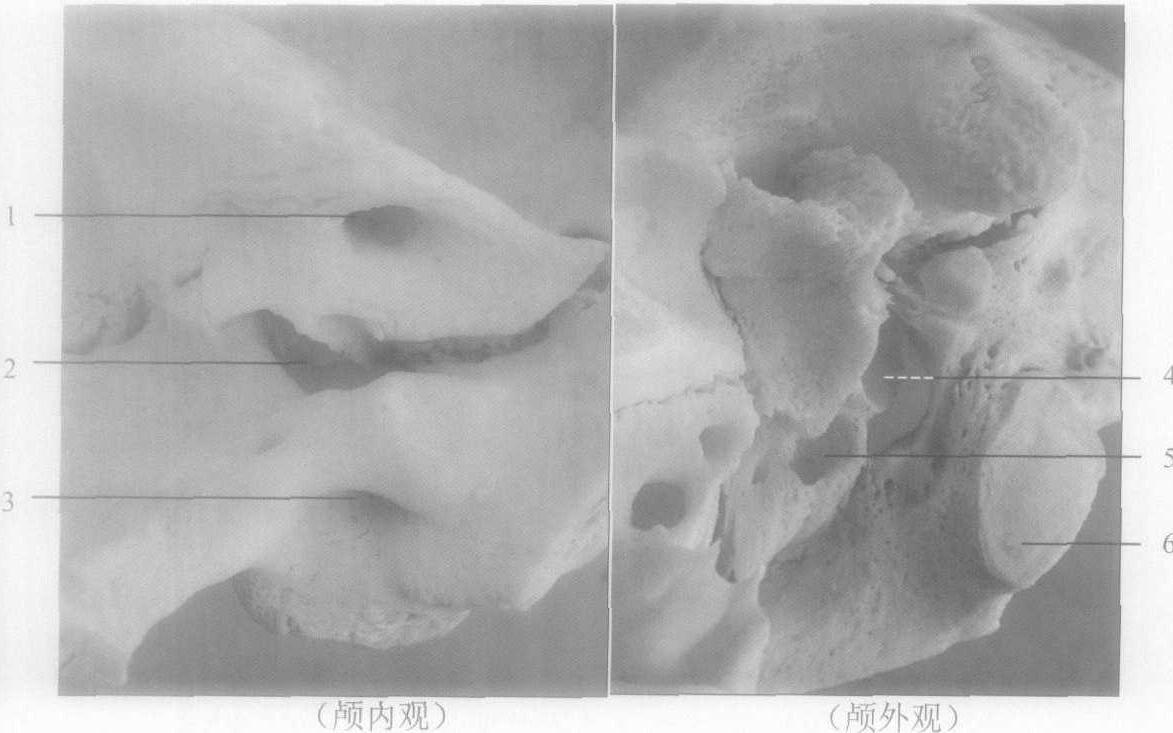 第十二部分 頸靜脈孔區(qū)的臨床應用解剖