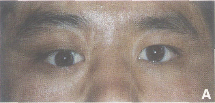 三、外側(cè)開眶