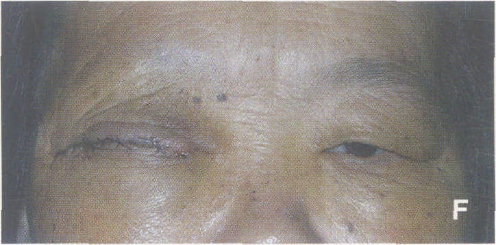 (二)全眶內(nèi)容摘除術(shù)