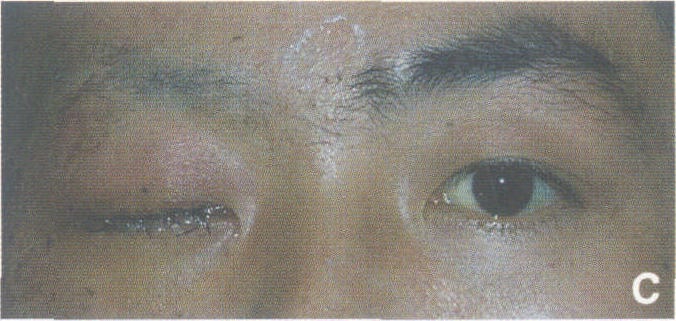一、治療角膜暴露手術
