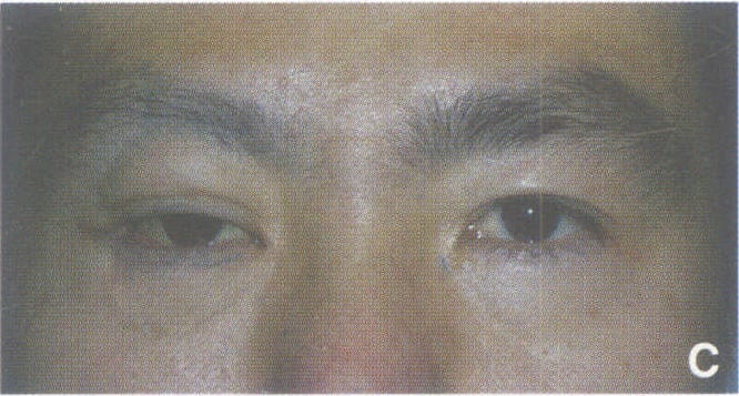 二、眶內(nèi)壁骨折