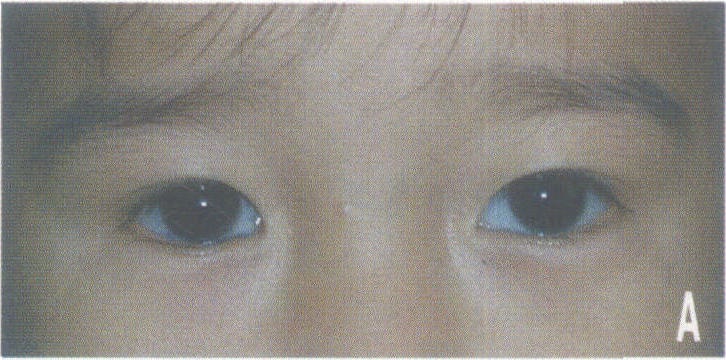 (一)視神經(jīng)膠質(zhì)瘤