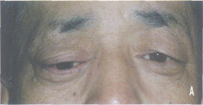 (二)淚腺腺樣囊性癌