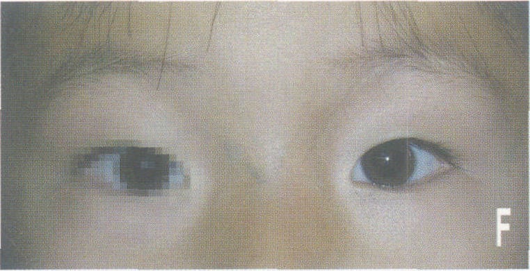六、眼眶橫紋肌肉瘤