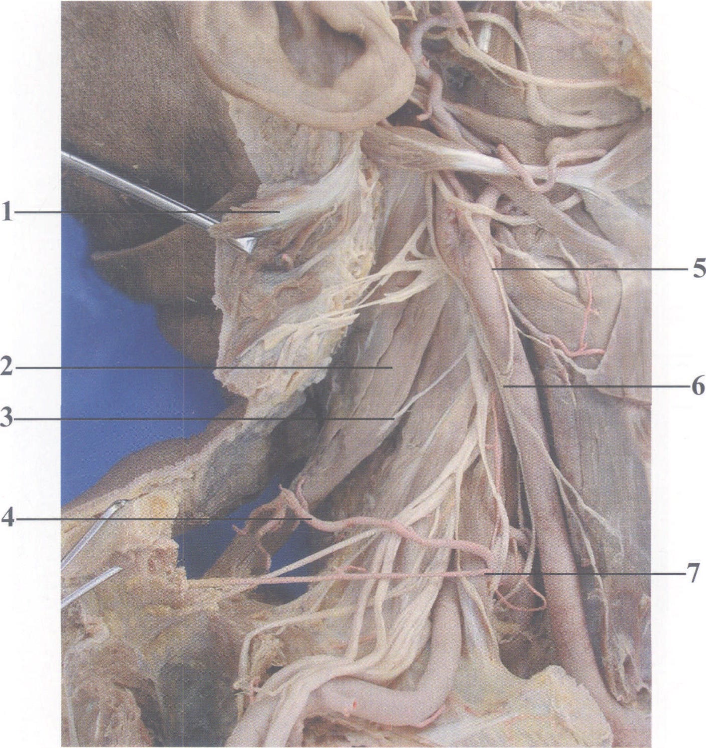 图3-5 肩胛提肌瓣