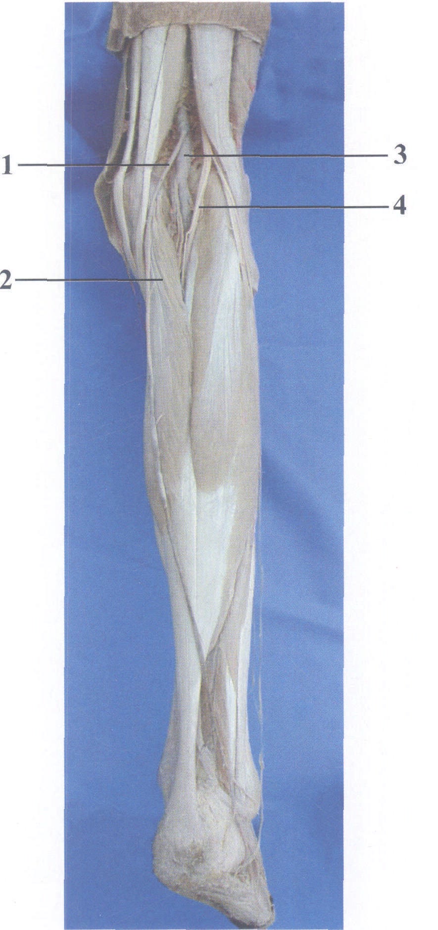 图3-32 腓肠肌(皮)瓣