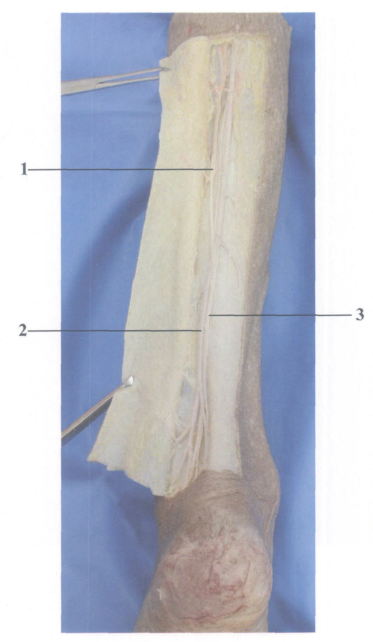 图5-5 腓肠神经瓣