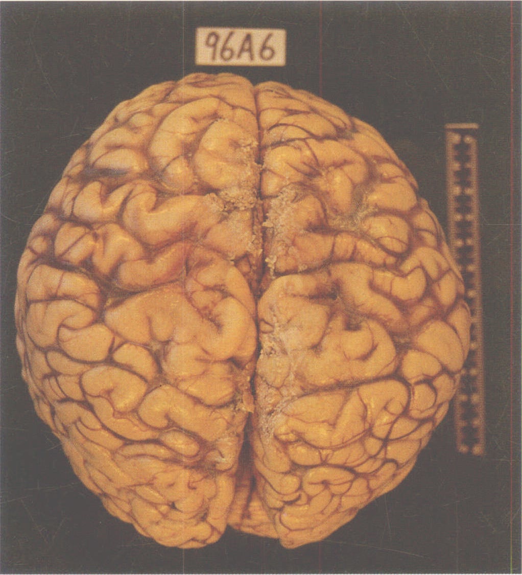 图1-1 26岁人脑的顶面观，示左、右侧大脑半球