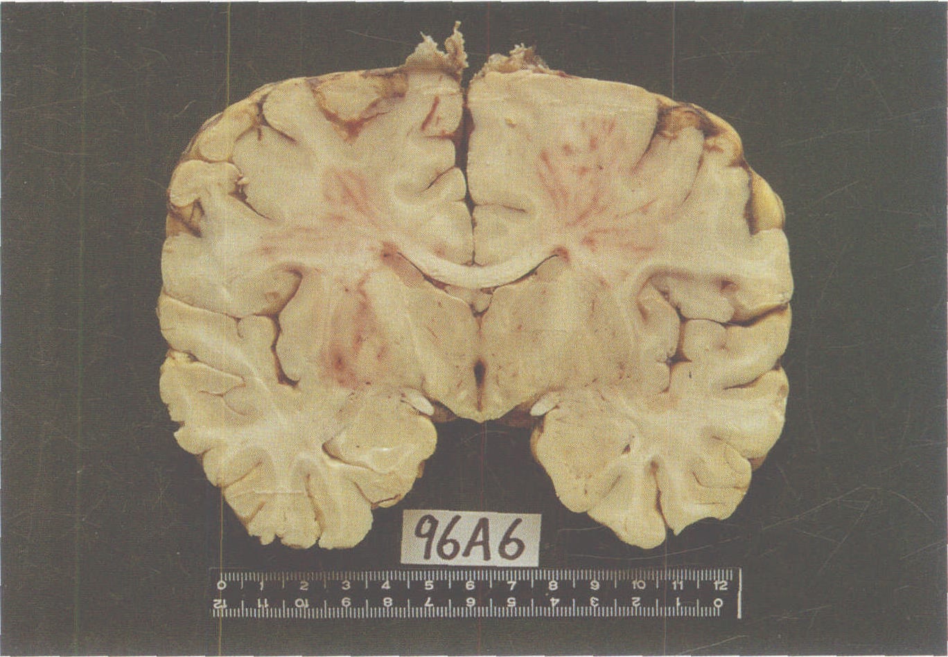 图1-4 经灰结节的人脑冠状切面，示大脑皮层，白质，胼胝体，两侧脑岛，视丘，基底节，内囊和海马前部