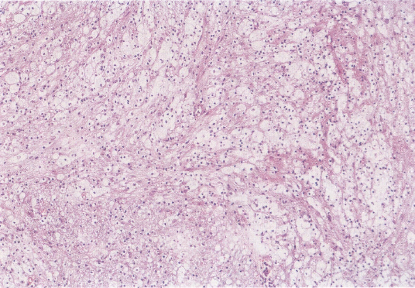图4-1-15 神经鞘瘤，肿瘤结构疏松，部分肿瘤细胞多角形，胞浆丰富，空泡状，可见微囊形成和粘液变性，即AntoniB型结构。HE染色，低倍