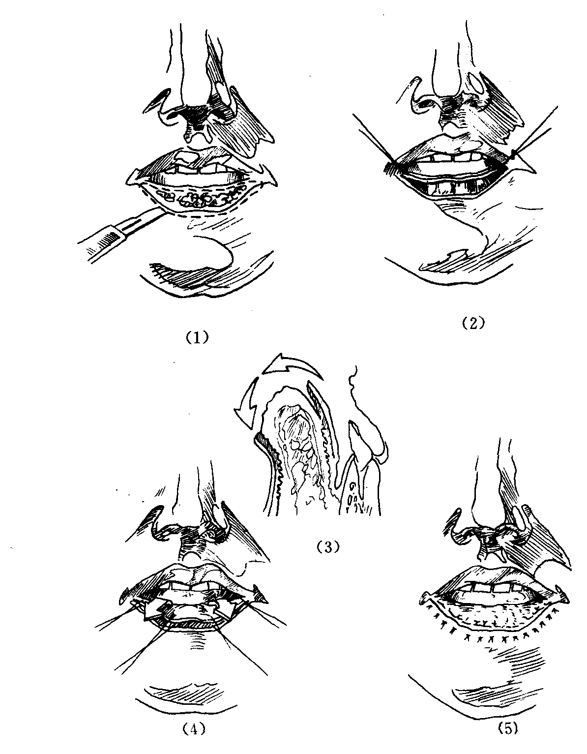 1.唇紅粘膜切除術(shù)的操作及修復(fù)