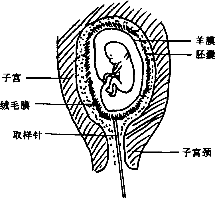 孕期绒毛检查