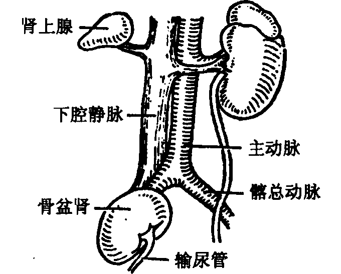 异位肾