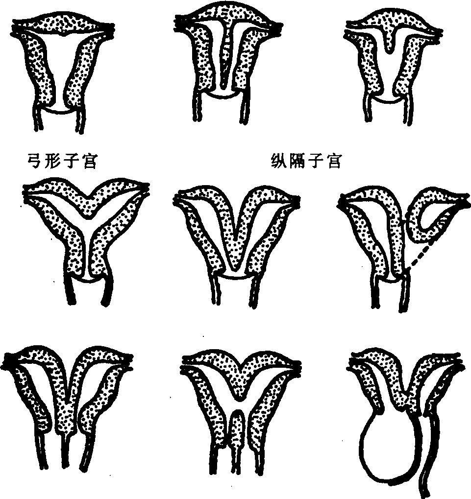 发育异常的子宫