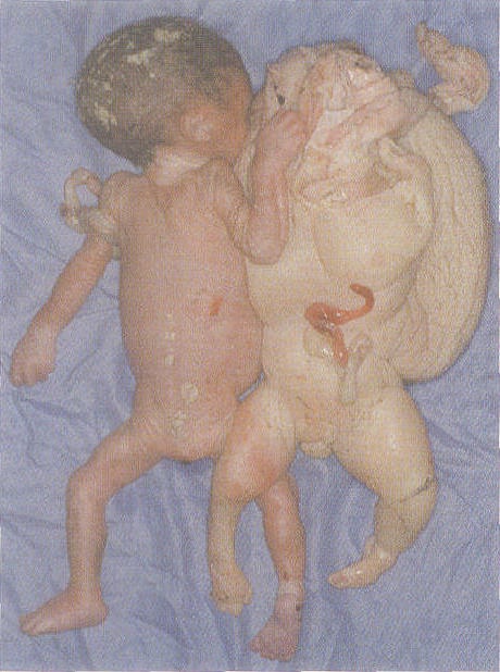 畸形的胎儿可表现为无头,无躯干或外观为一个肉球