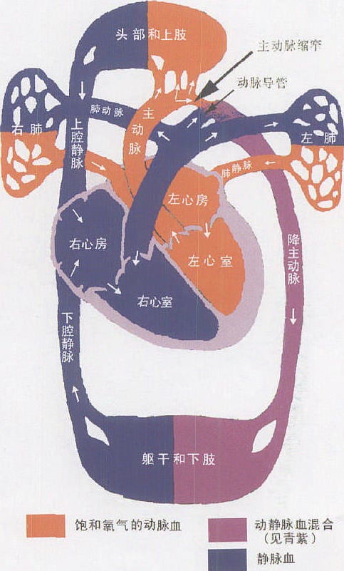 動(dòng)脈導(dǎo)管未閉