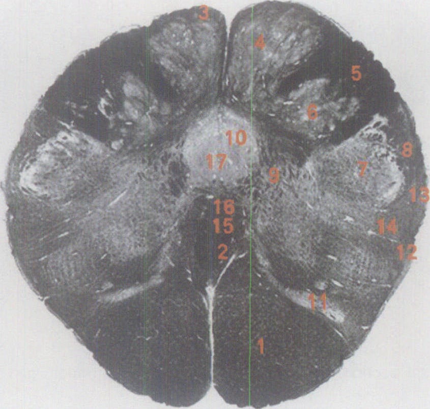 延髓横断面解剖图图片