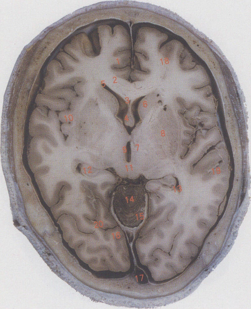 大脑第三脑室图片图片