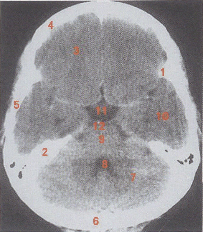 4thventricle9脑桥pons10颞叶temporallobe11垂体柄pituitarystalk12