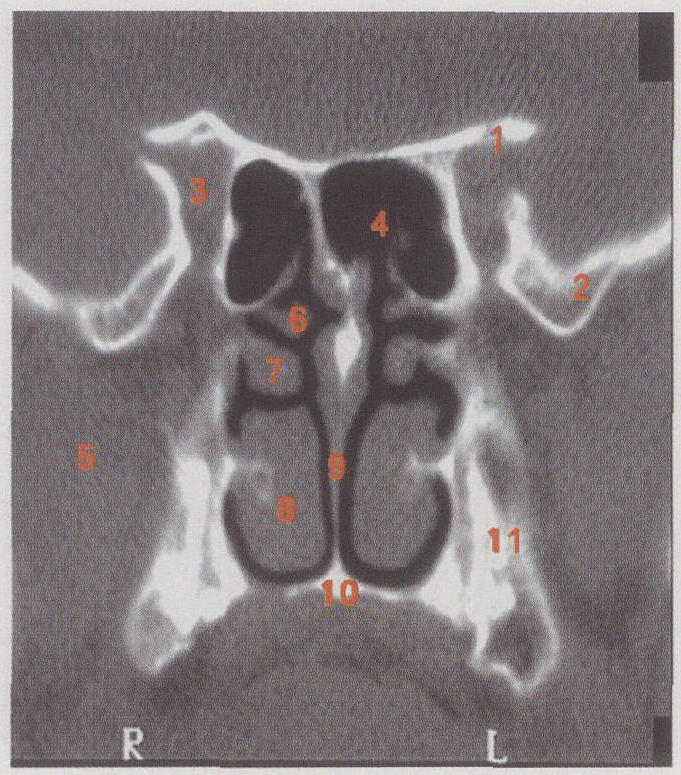 boney nasal septum图片