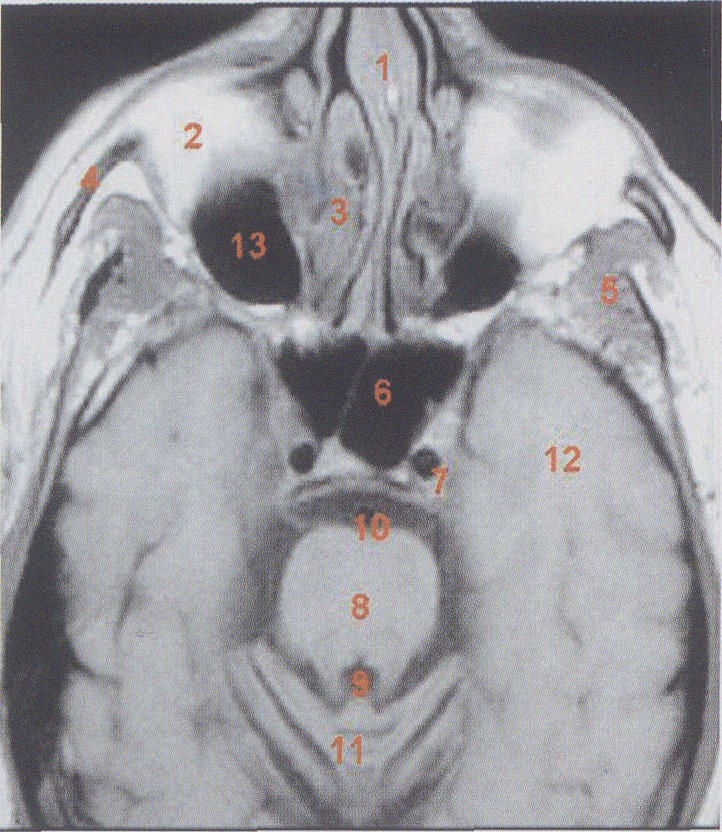 boney nasal septum图片