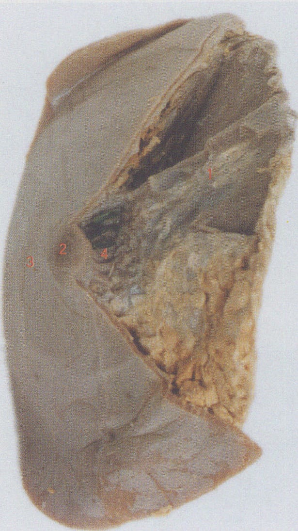 乳腺纤维腺瘤大体标本图片