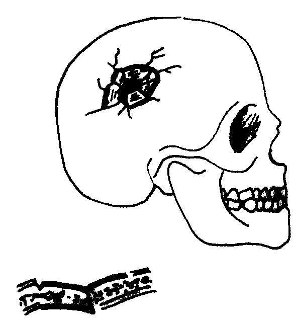 第一節(jié) 骨折定義、病因、移位和分類