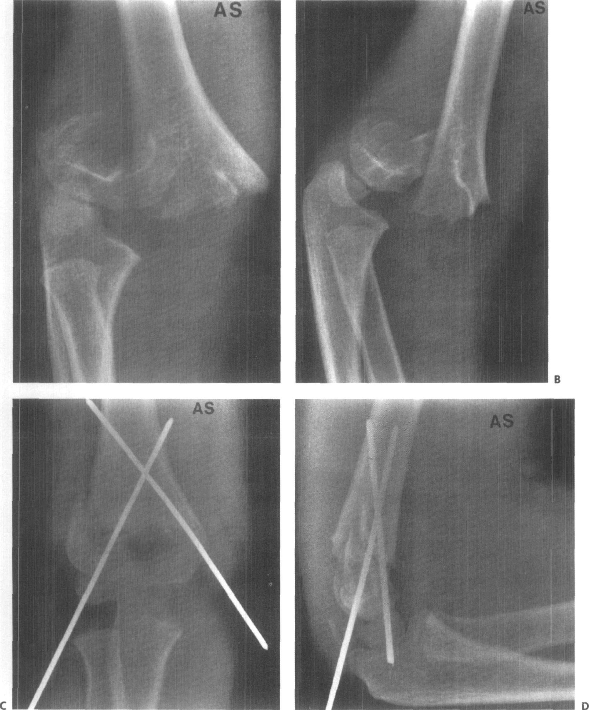 病例15 肱骨髁上骨折(伸直型)-特种医学-医学