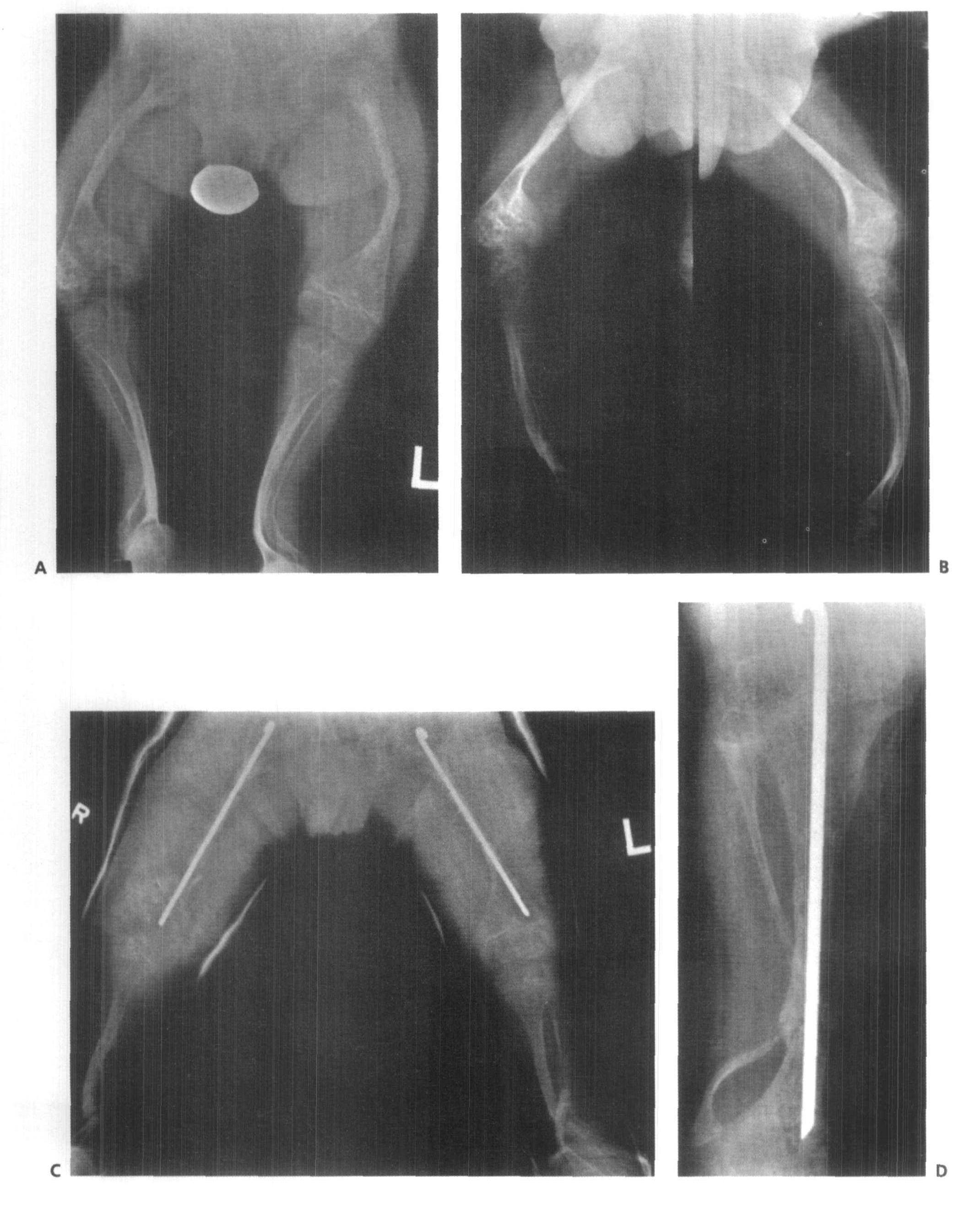 6.7 节段性截骨、髓内针固定治疗胫骨成骨不全畸形:sofield技术