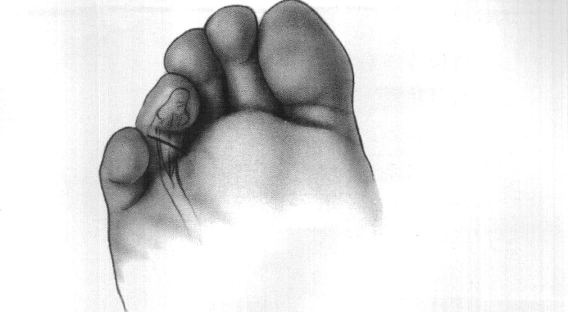 跖趾关节屈曲时,近侧趾间关节可伸直儿童期这
