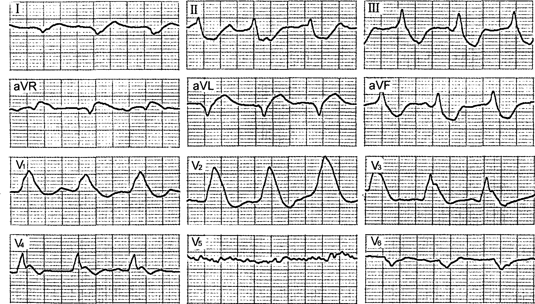 酷似心肌梗死的暴发性心肌炎心电图