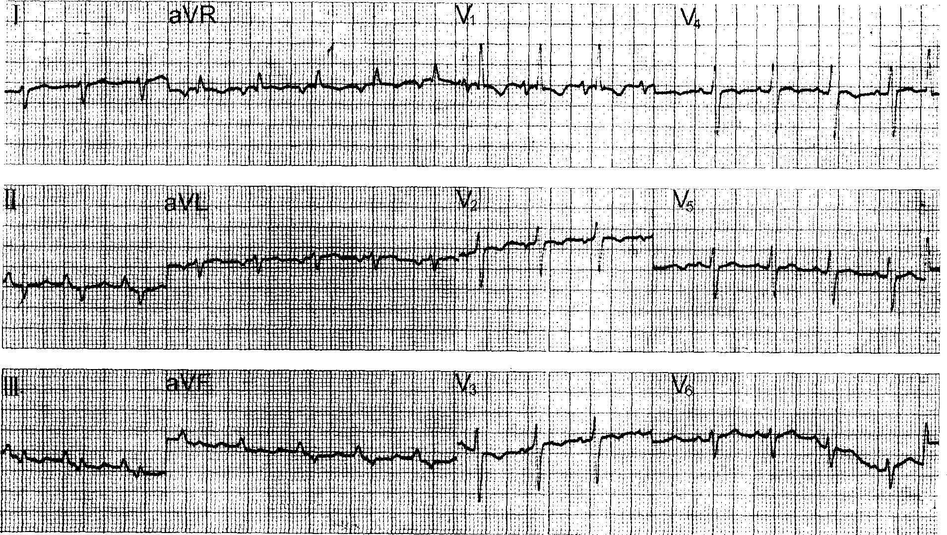 三、右心室肥大(图1-31～1-39)