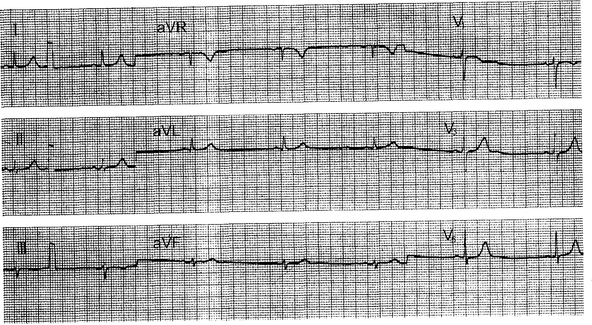 60种常见心电图一览（第二篇-室上性心率失常） - 知乎