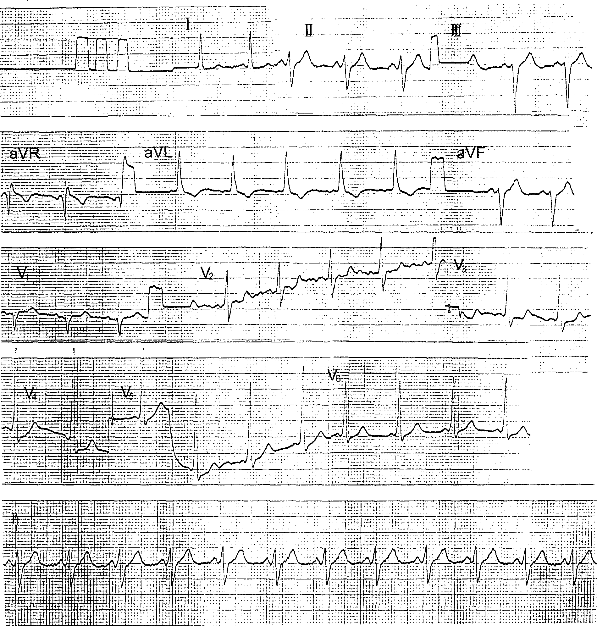 心房颤动伴b型预激(图3