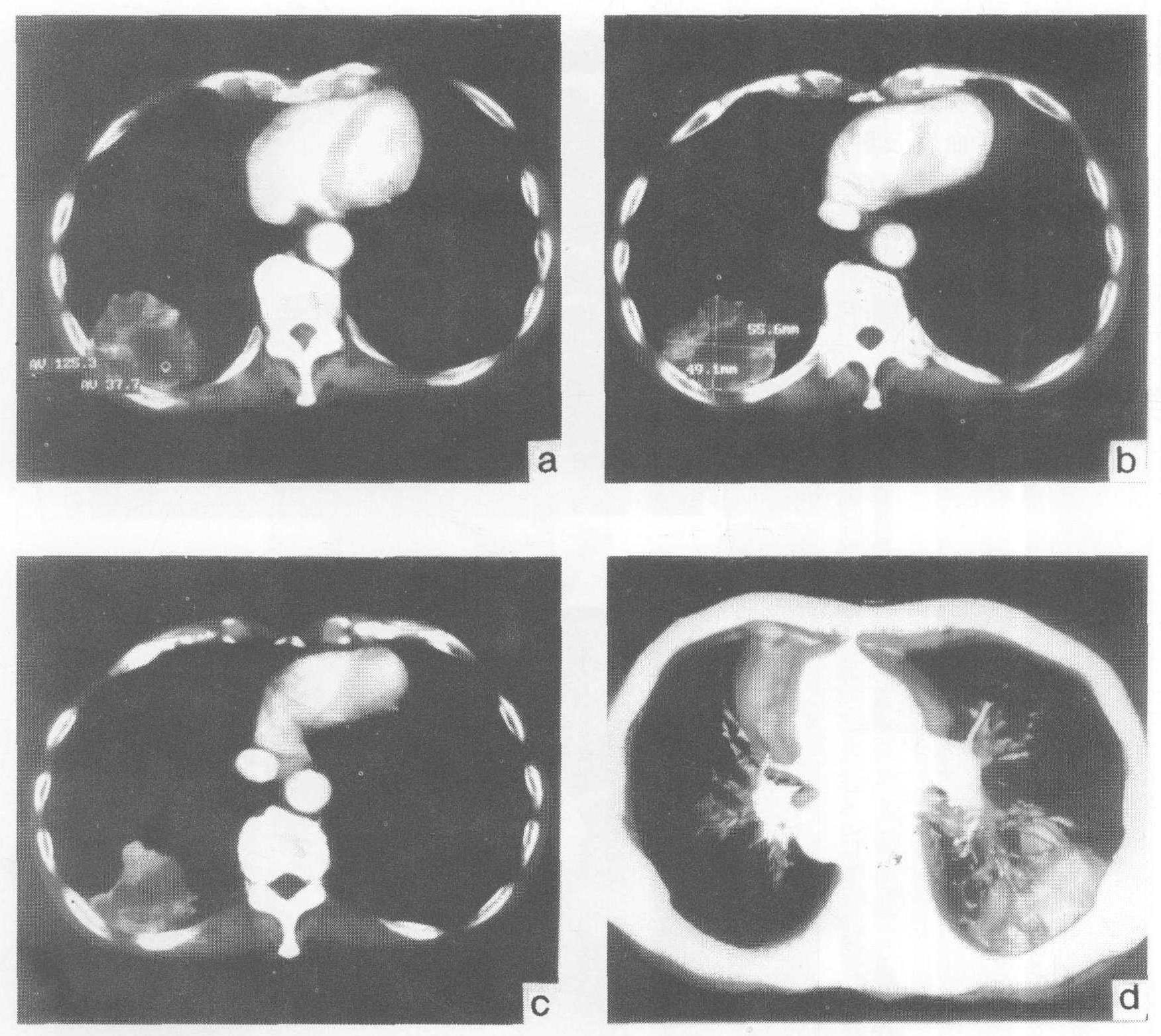 三、螺旋CT在胸部疾病诊断中的应用