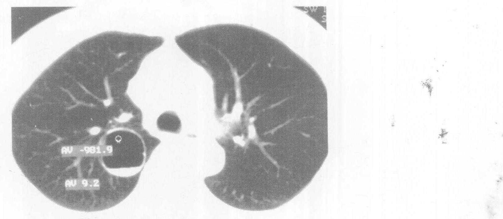 七、先天性囊腺瘤樣畸形