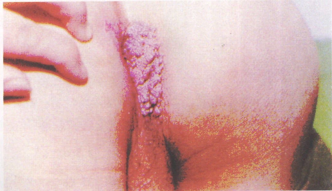 第四節(jié) 尖銳濕疣