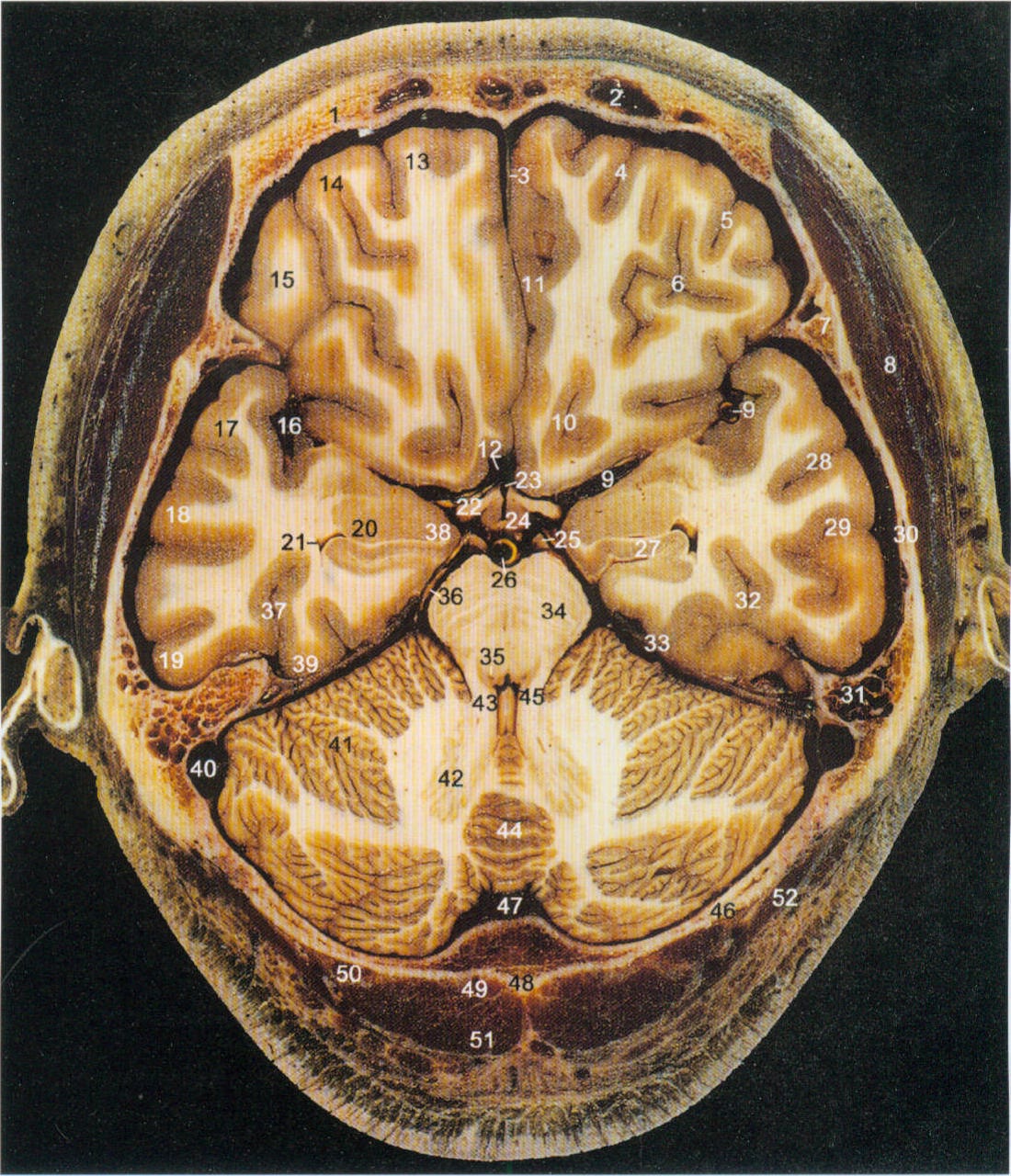 小脑中脚断层解剖图片