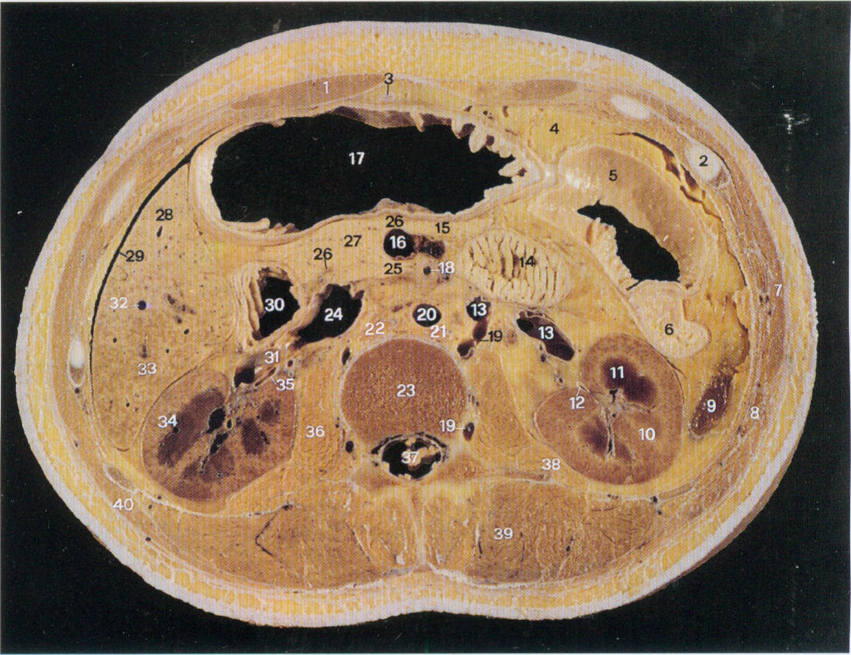 大网膜ct解剖图片