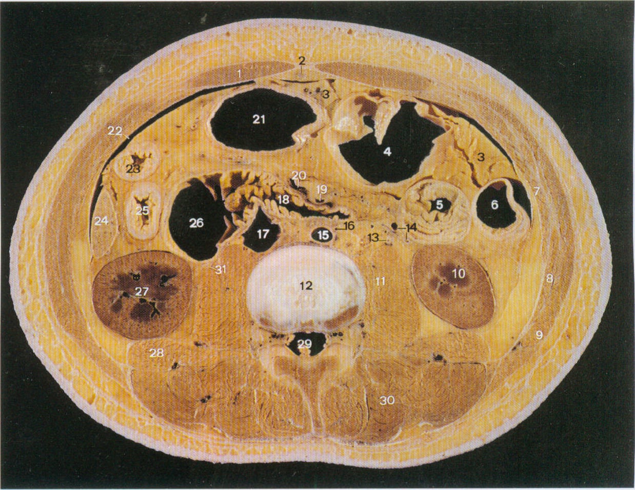 transversus abdominis图片