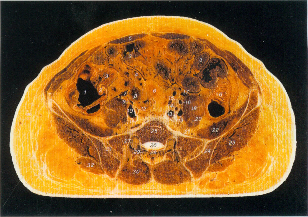 sigmoid colon图片
