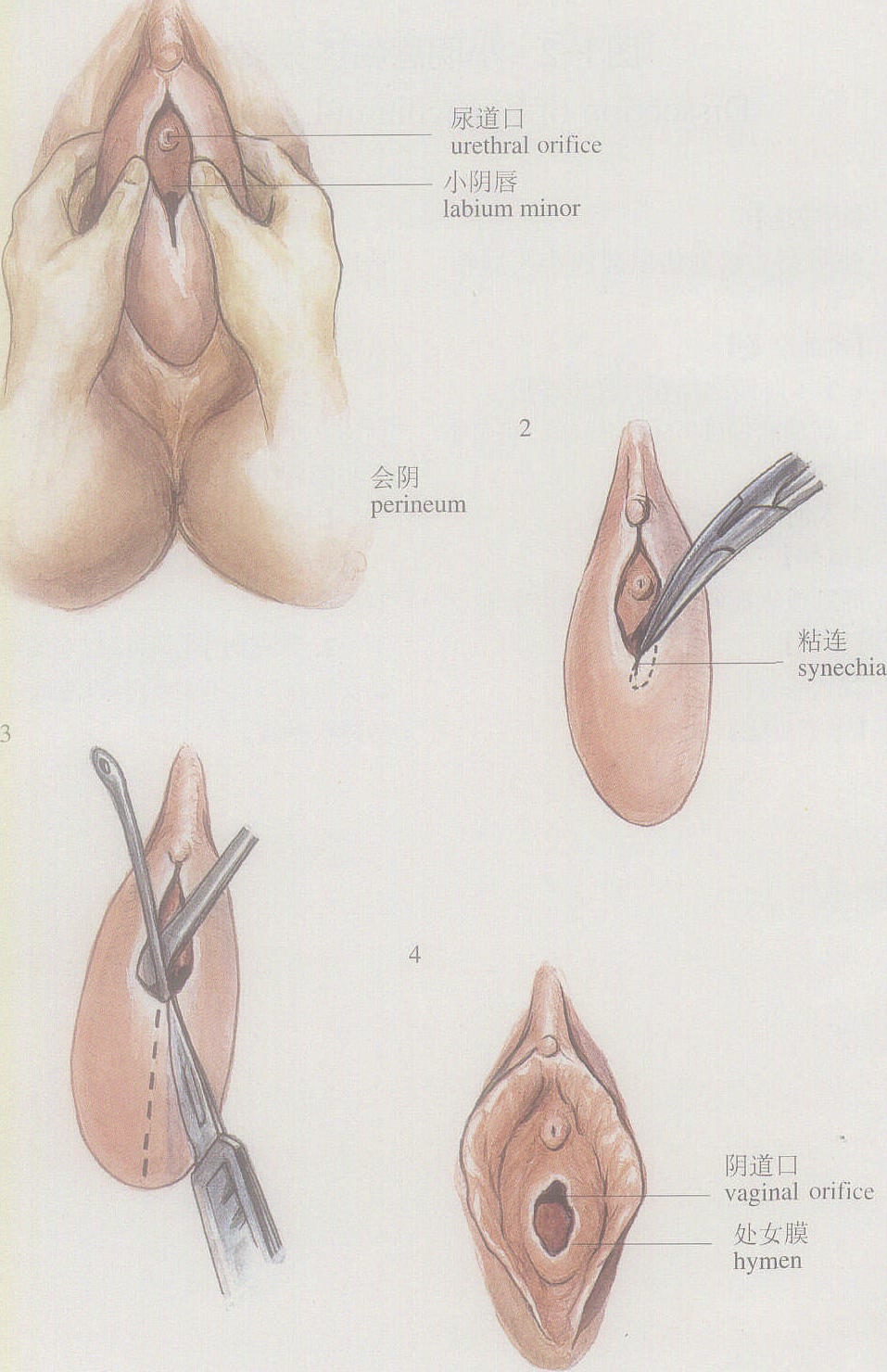 图1-2小阴唇粘连分离术