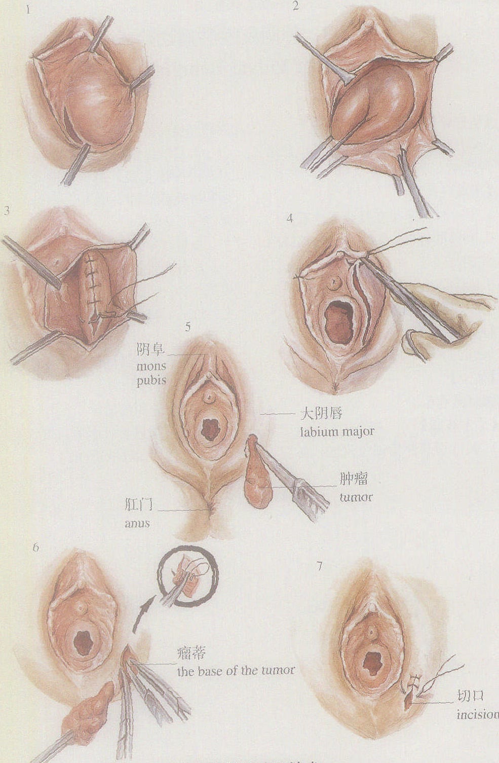 图1-3外阴良性肿瘤切除术